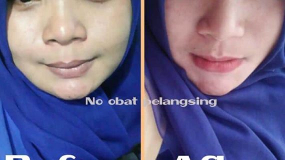 LANSING TANPA OBAT