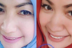 Serasa Abis Oplas